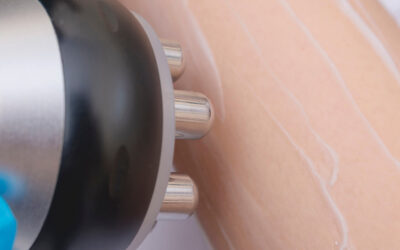 What Is a XERF Skin Tightening Treatment and How Does It Work?