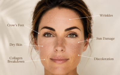 Summer Sun Damage: Causes, Treatments & How to Restore Your Skin